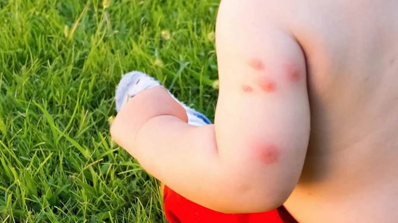 Bed bug bites on baby: Symptoms and Natural way of prevention