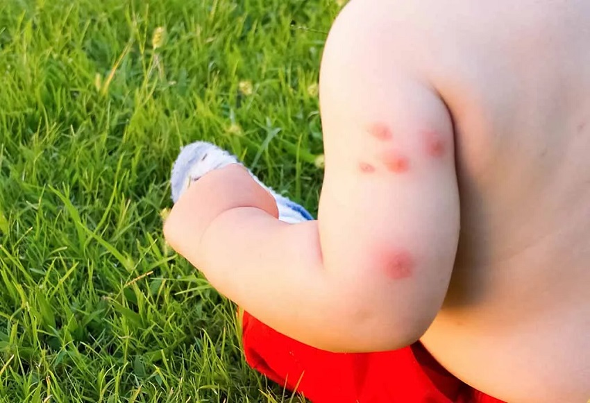 Bed bug bites on baby